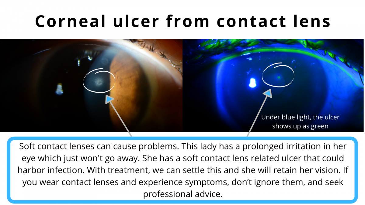 Soft contact lenses can cause problems. This lady has a prolonged irritation in her eye which wont go away. She has a soft contact lens related corneal ulcer that could harbor infection.